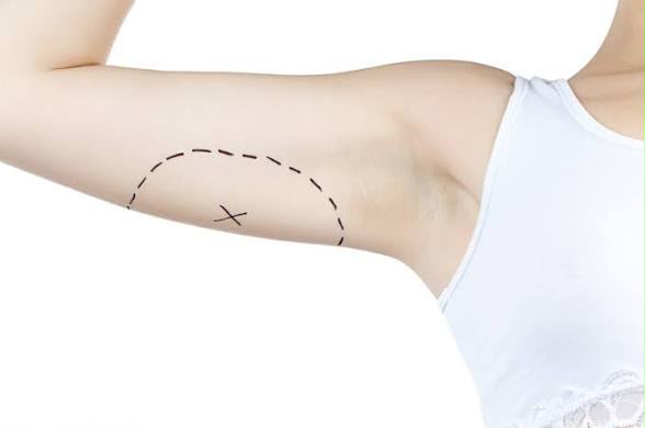 Lifting delle braccia da EsteCenter Istanbul