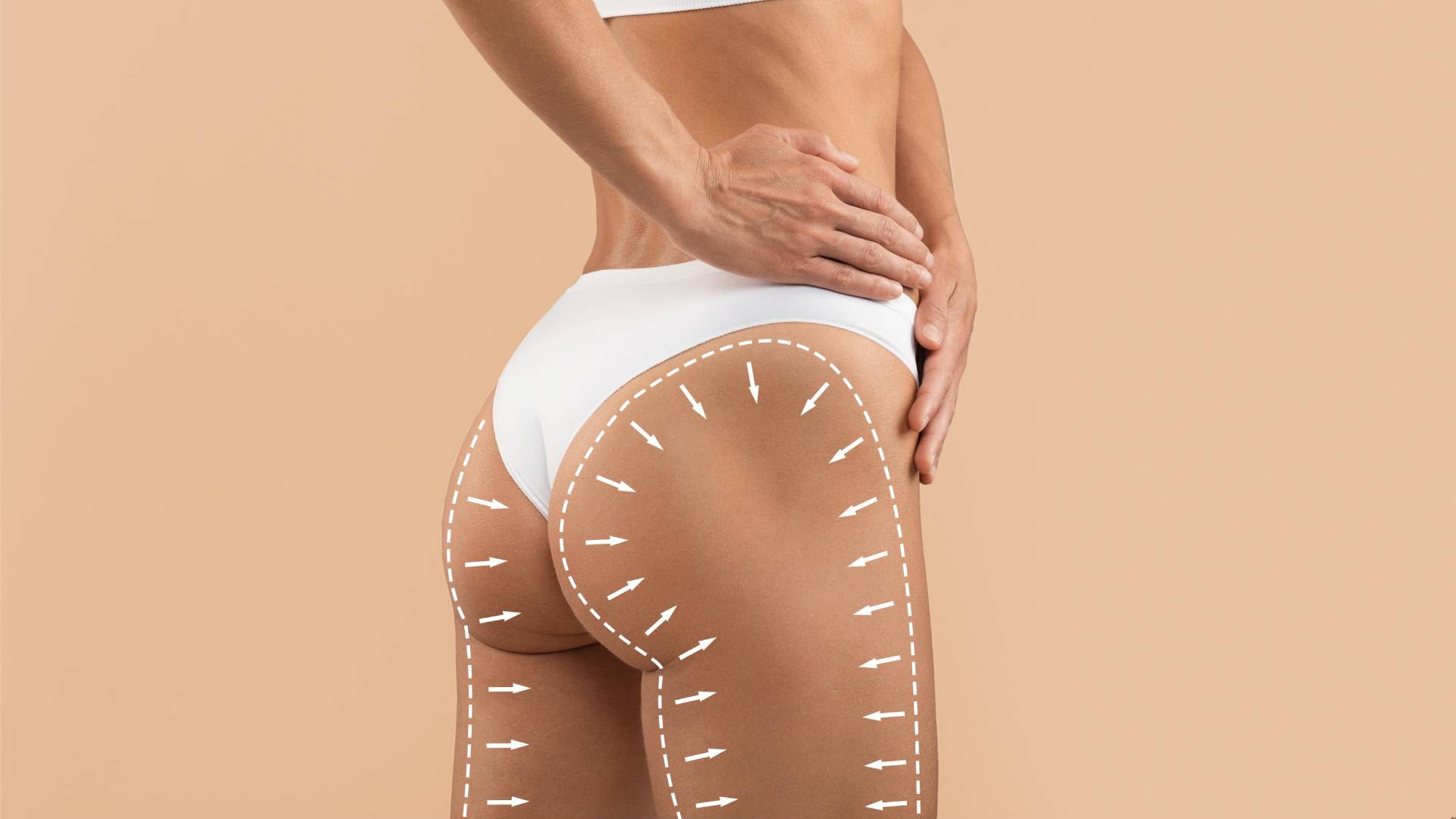 Brazilian Butt Lift (BBL) da EsteCenter Istanbul