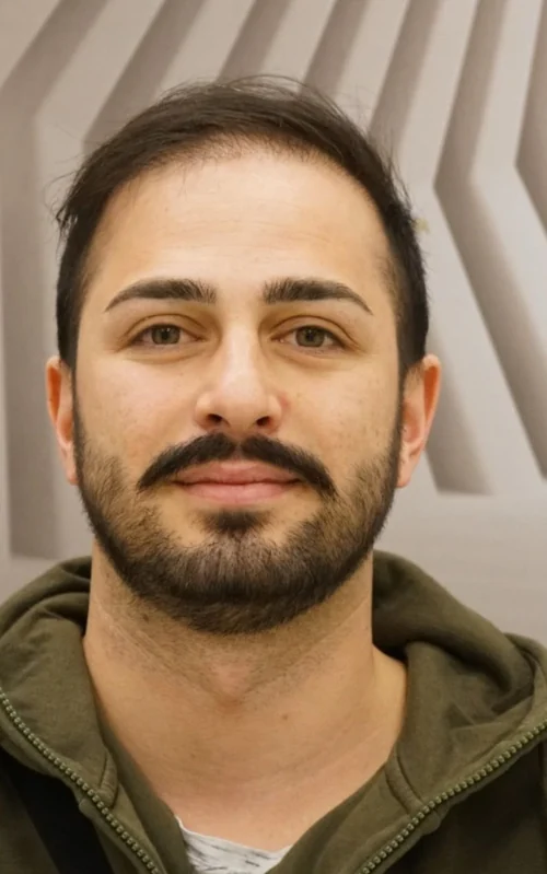 Prima del trapianto di capelli