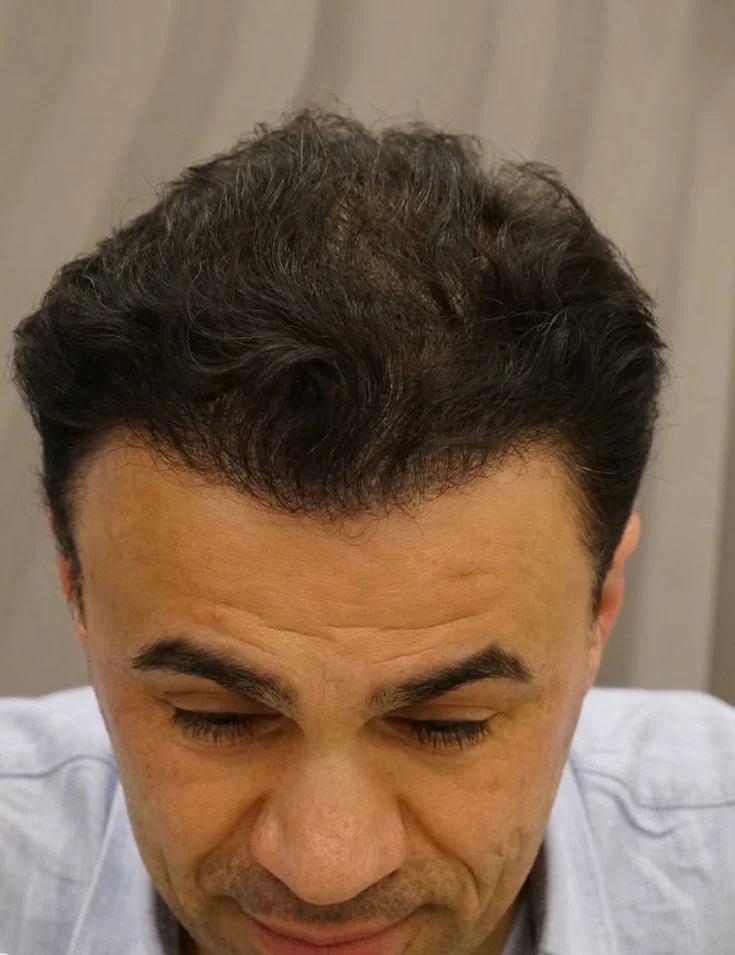 Risultato dopo il trapianto di capelli