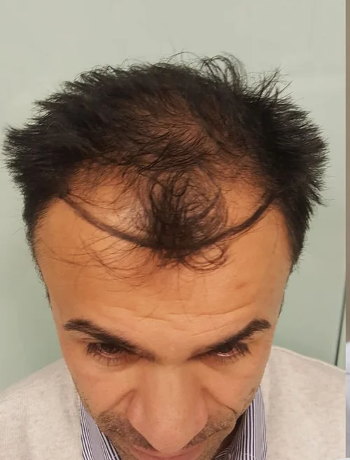 Prima del trapianto di capelli