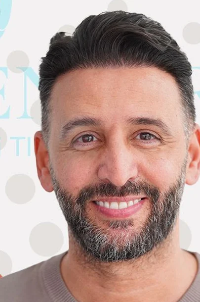Risultato dopo il trapianto di capelli