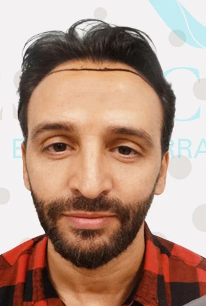 Prima del trapianto di capelli