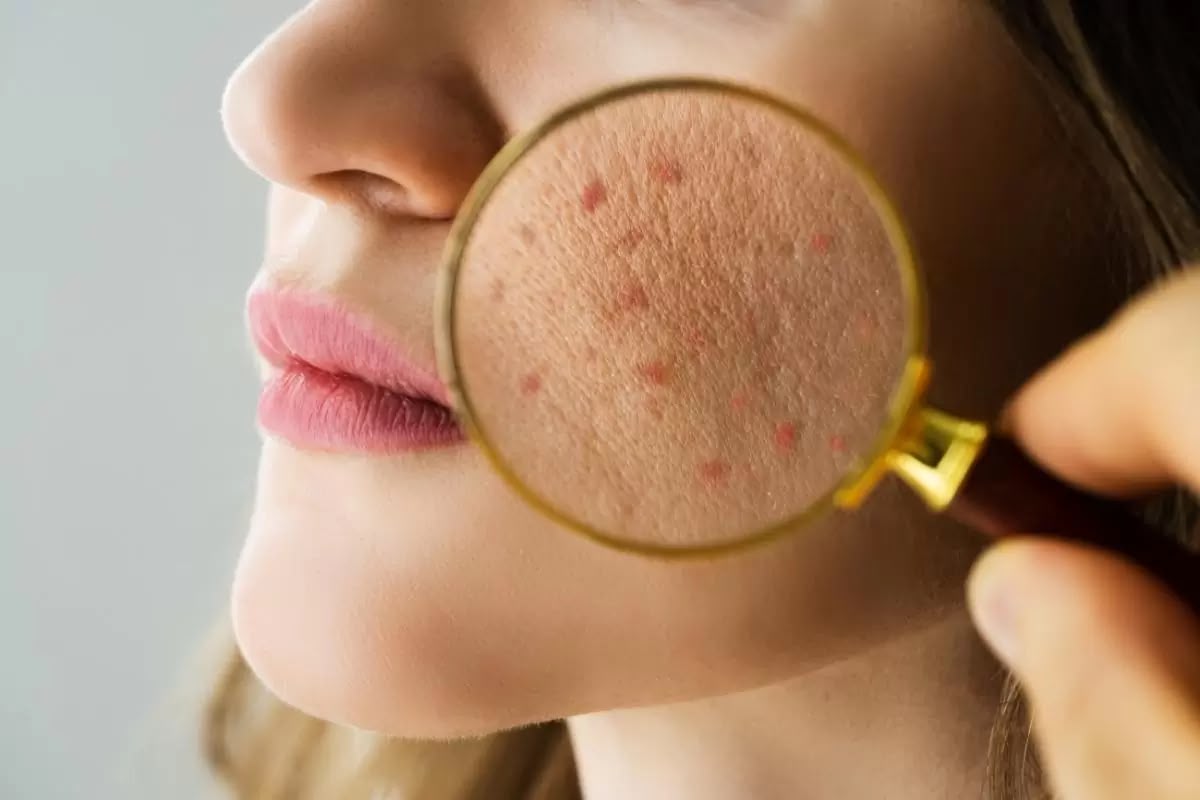 Trattamento dell'acne in EsteCenter Istanbul
