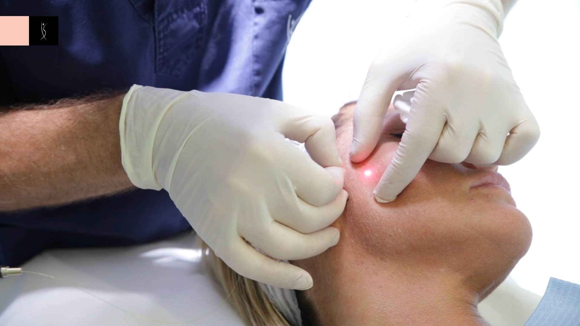 Lifting Laser Endolift all'EsteCenter Istanbul