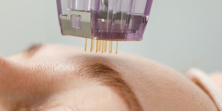 Microneedling a radiofrequenza Scarlet X Golden Needle presso EsteCenter Istanbul