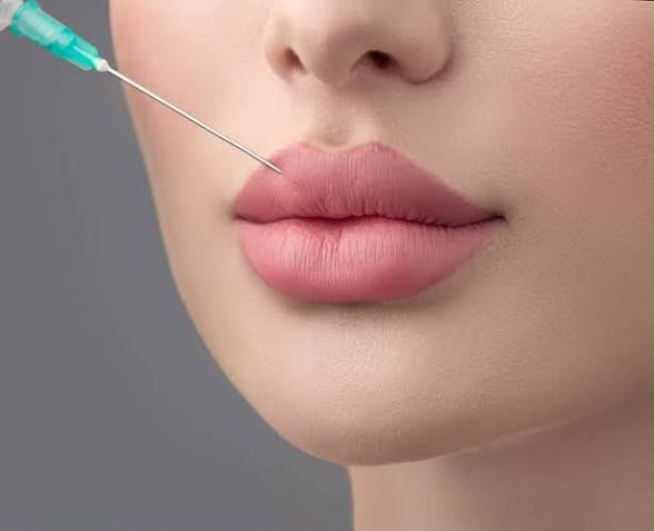 Trattamento filler labbra a EsteCenter Istanbul