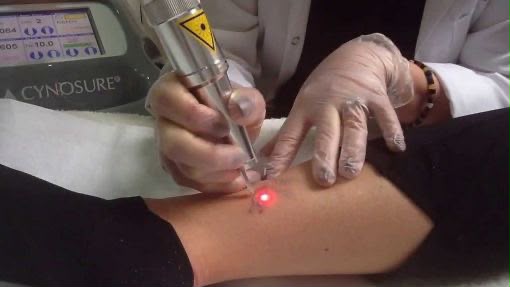 Trattamento della pelle con laser Mydon presso EsteCenter Istanbul