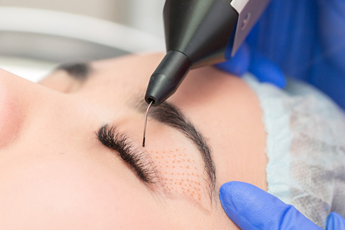 Chirurgia delicata al plasma Plexr presso EsteCenter Istanbul