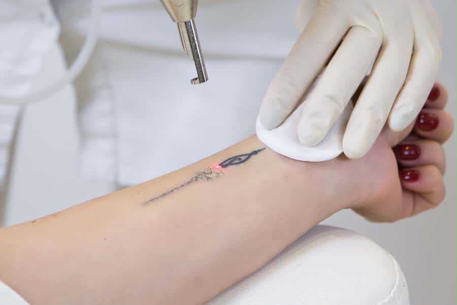 Rimozione tatuaggi laser presso EsteCenter Istanbul