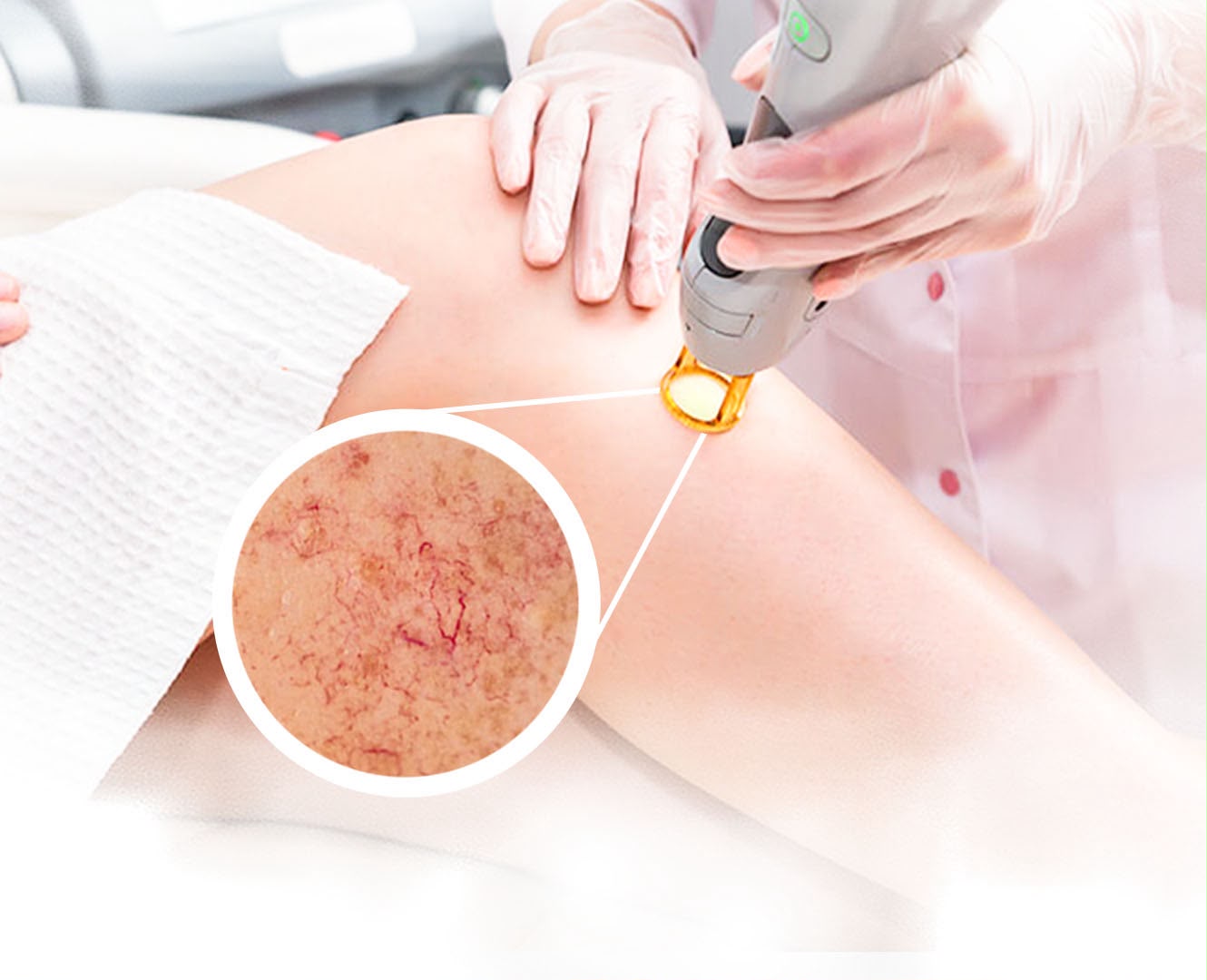 Trattamento laser vascolare dei capillari presso EsteCenter Istanbul
